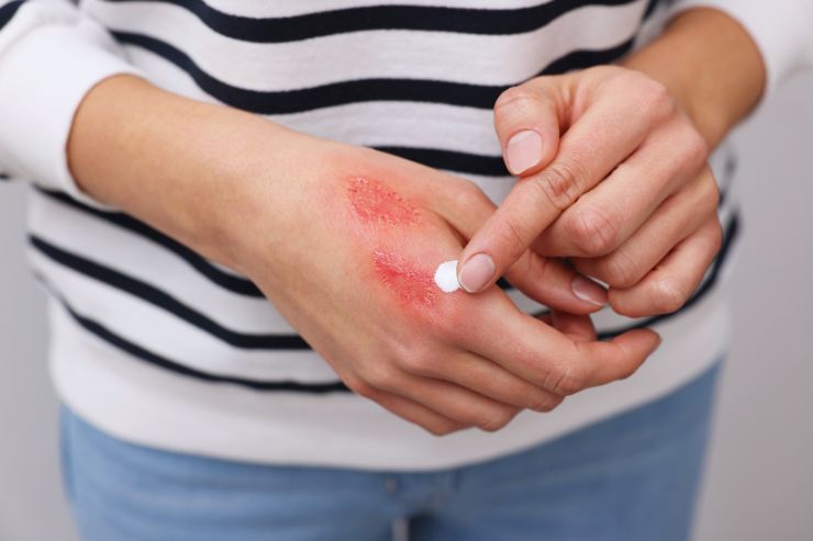 mani con bruciatura